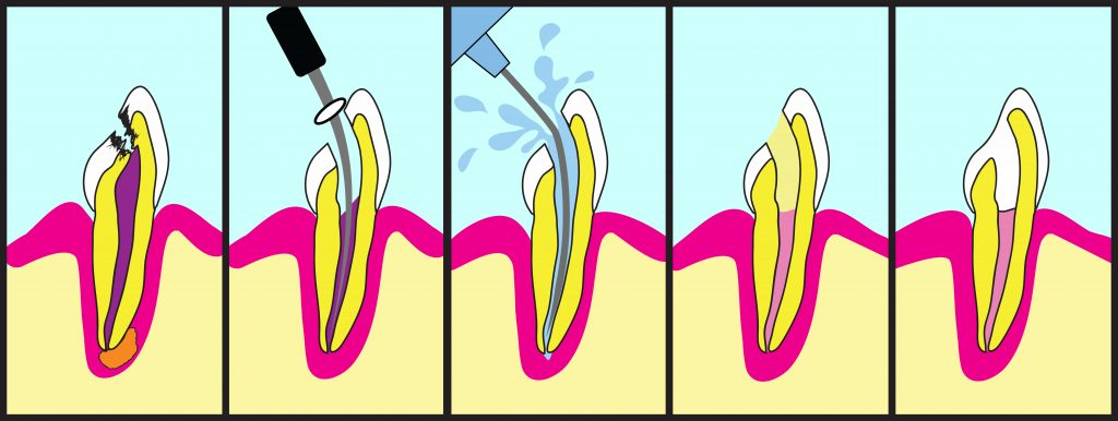 Root canal treatment graphics in five steps